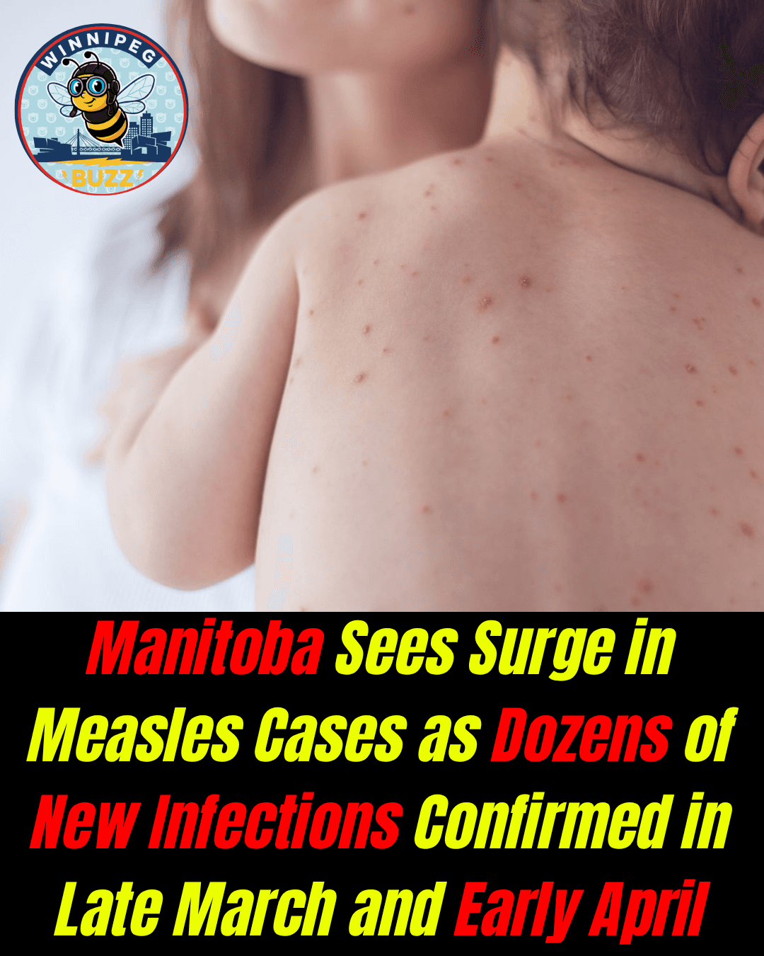 Manitoba Sees Surge in Measles Cases as Dozens of New Infections Confirmed in Late March and Early April