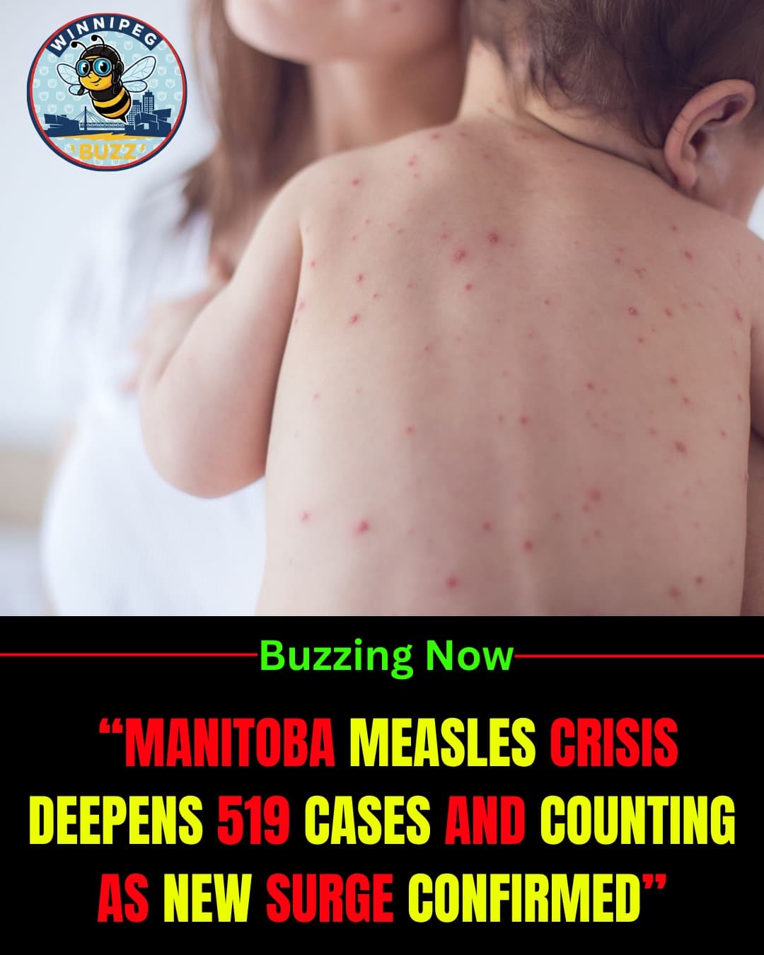 Manitoba Measles Outbreak Grows to 519 Cases as 22 New Infections Confirmed in Ongoing Surge