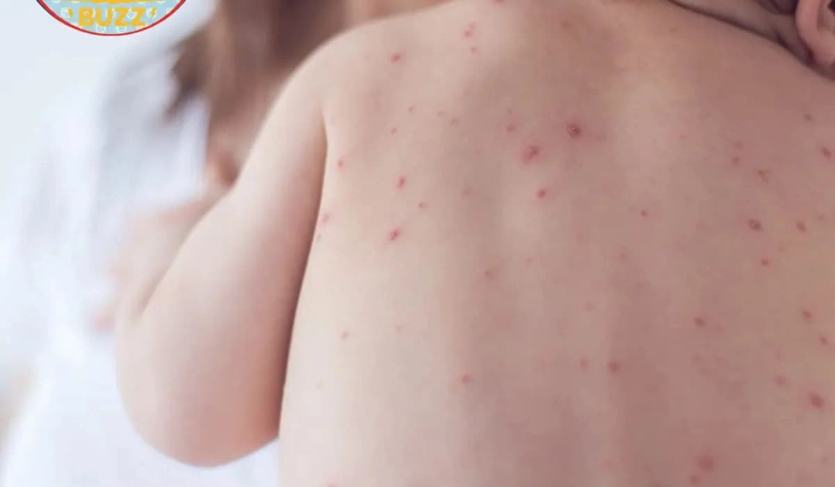 Manitoba measles outbreak 2026 showing rising infection cases in March and April